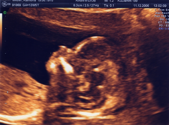 Ultraschall_1