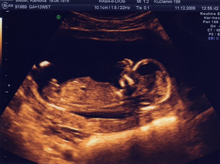 Ultraschall_2