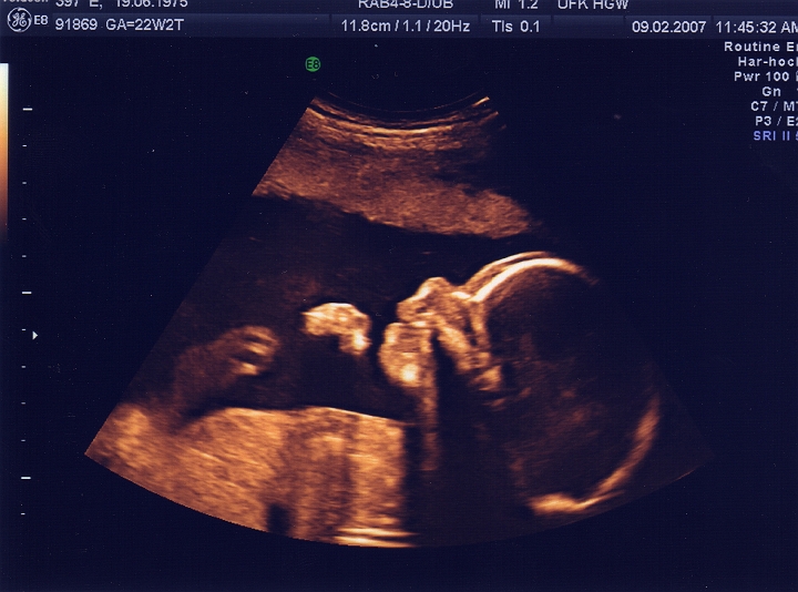 Ultraschall_3