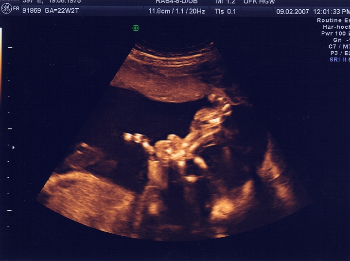 Ultraschall_4