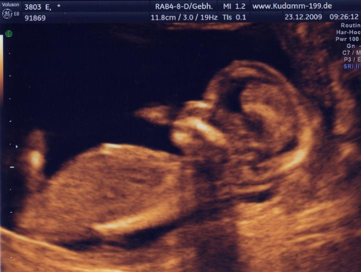 Ultraschall_091223_01