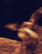 Ultraschall_091223_01