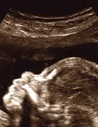 Ultraschall_100224_2